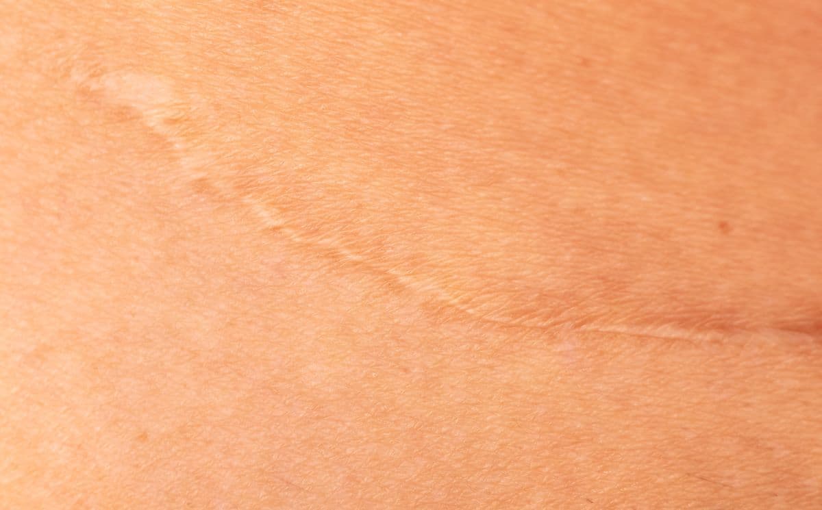 naturheilkunde-praxis-maureen-liebschner-zuerich-narbenentstoerung-narbenbehandlung-massagen